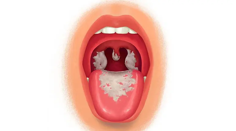Diphtheria Spreads in Coimbatore: Symptoms and Prevention of Diphtheria