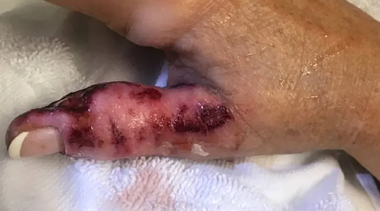 Flesh-Eating Bacterial Disease: Thumb lost after the manicure by a Tennessee woman