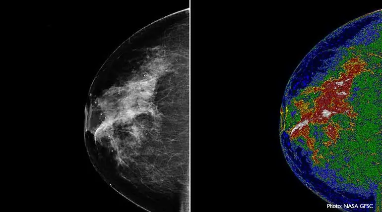 Is 3D breast cancer detection better than the 2D?