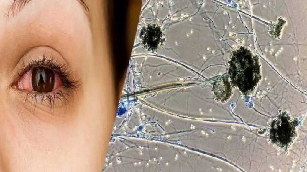 Rising Black Fungus Infection in Tamil Nadu: 921 cases so far In TN