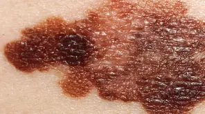 Skin Cancer: Vitamin D can Scrutinize Melanoma via VDR