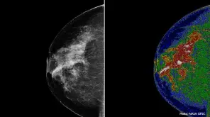 Is 3D breast cancer detection better than the 2D